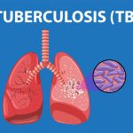Wamenkes: Kematian Akibat TBC Lebih Tinggi dari COVID-19 Tapi Tak Dianggap Serius